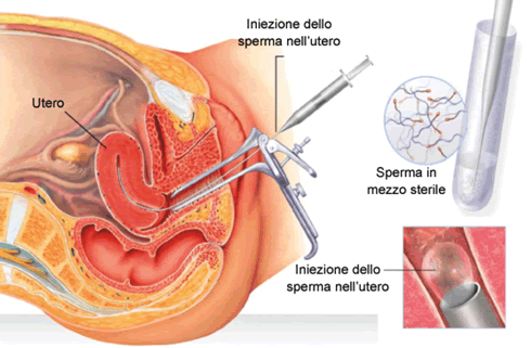 intrauterina