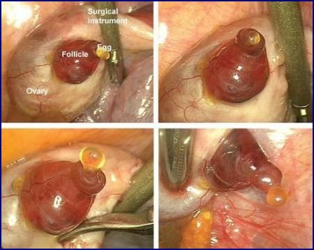 doctorj ovulazione in corso in laparoscopia 080111